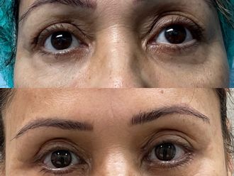 Blefaroplastia antes y después - 878799