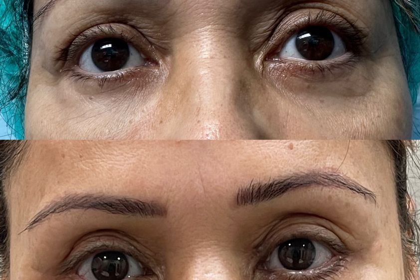Blefaroplastia antes y después - 878799