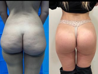 Aumento glúteos antes y después - 878890