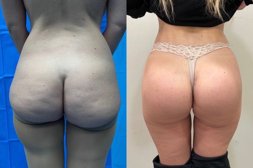 Aumento glúteos antes y después - 878890