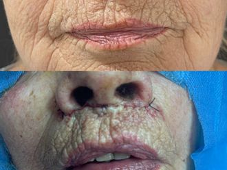Queiloplastia antes y después - 878905