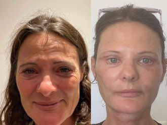 Lifting antes y después - 878910