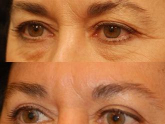 Blefaroplastia antes y después - 878912