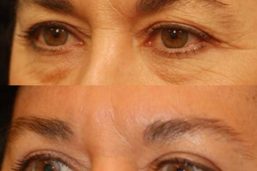 Blefaroplastia antes y después - 878912