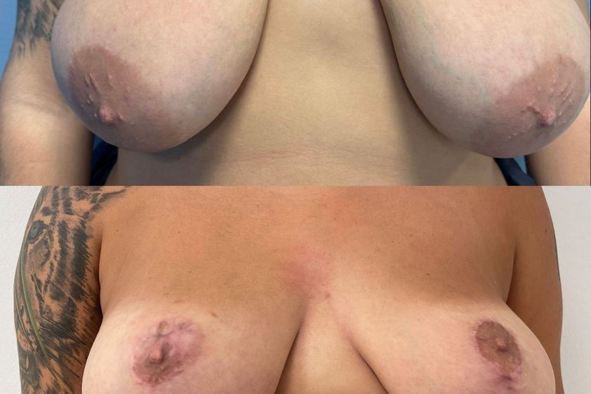 Mastopexia antes y después - 878914