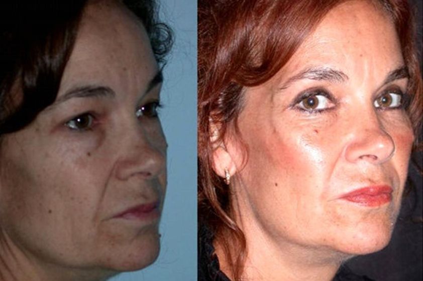 Aumento pómulos antes y después - 494993