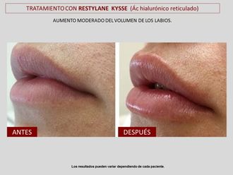 Aumento labios - 606796