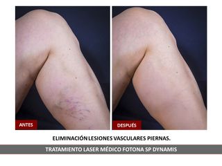 Belia Clinic - Eliminación de lesiones vasculares
