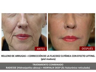 Belia Clinic - Rejuvenecimiento facial