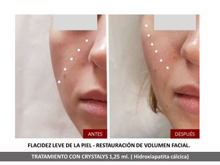 Belia Clinic - Rellenos Faciales