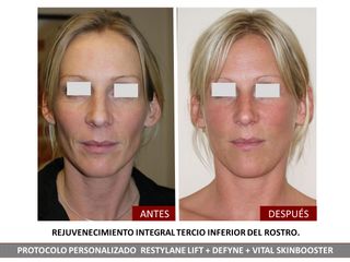 Belia Clinic - Rejuvenecimiento facial