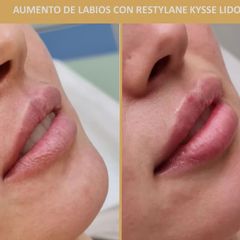 Aumento de labios - Belia Clinic