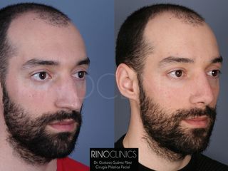 Antes y después Rinoplastia 
