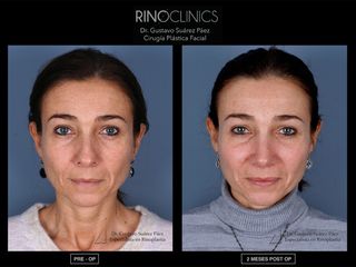 Antes y después Rinoplastia ultrasonica
