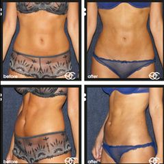 Antes y después Abdominoplastia