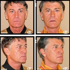 Antes y después Rejuvenecimiento facial
