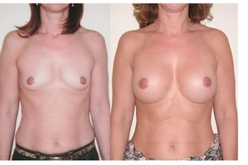 Antes y depués aumento de pecho 