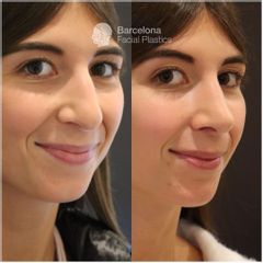 Rinoplastia - Barcelona Facial Plastics