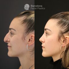 Rinoplastia - Barcelona Facial Plastics