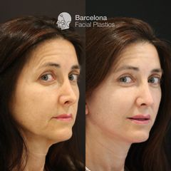 Lifting y rinoplastia secundaria - Barcelona Facial Plastics