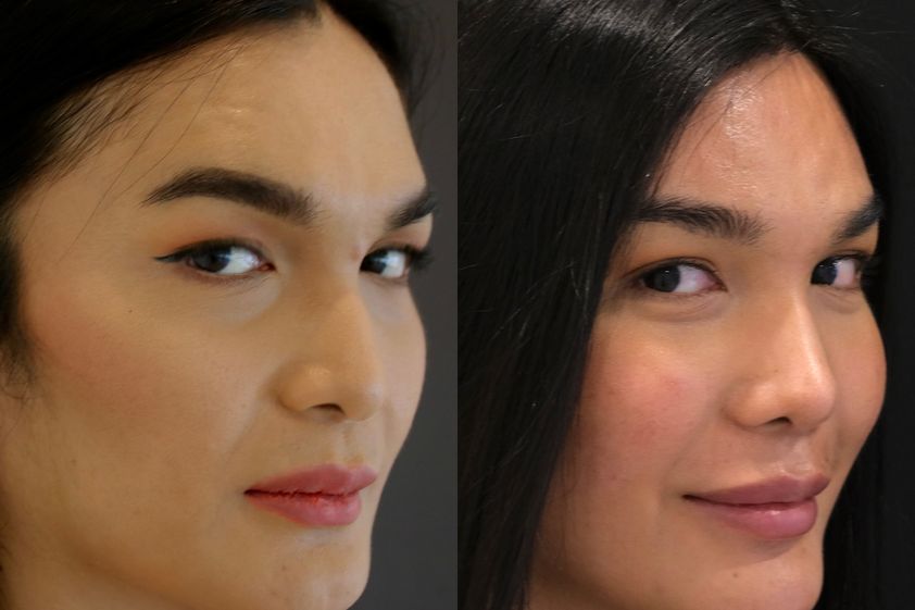 Cirugía maxilofacial antes y después - 817318