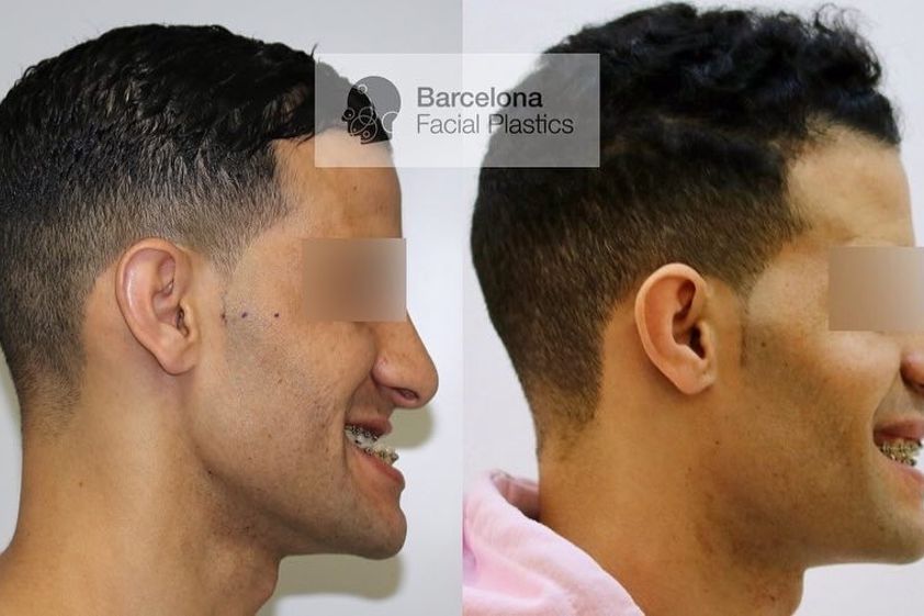 Cirugía maxilofacial antes y después - 817320