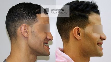 Cirugia ortognática bimaxilar - Barcelona Facial Plastics