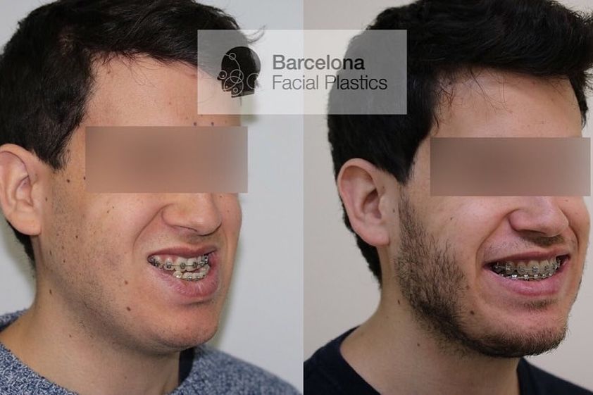 Cirugía maxilofacial antes y después - 817321