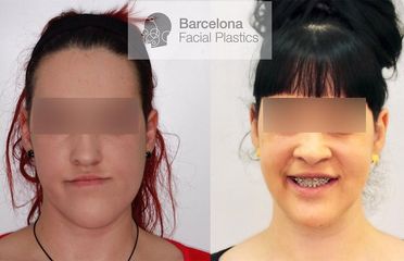 Cirugía ortognática bimaxilar - Barcelona Facial Plastics