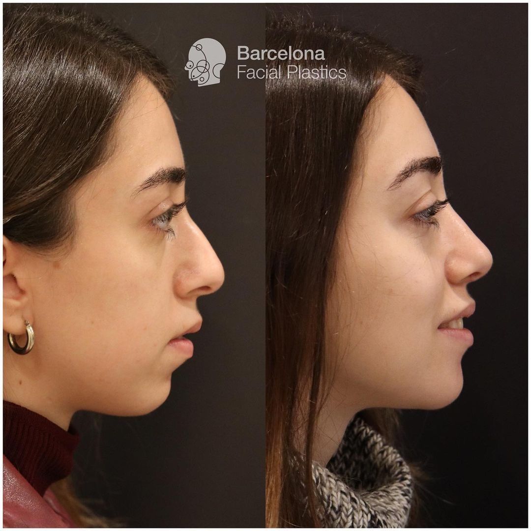 Cirugía maxilofacial Antes y después - Multiestetica.com