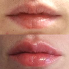 Aumento de labios - Dra. Gracia Alonso