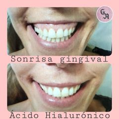 Sonrisa gingival - Dra. Gracia Alonso