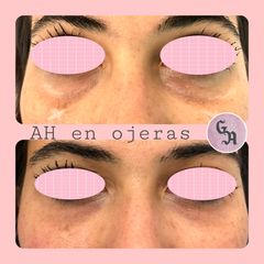 Eliminación de ojeras - Dra. Gracia Alonso