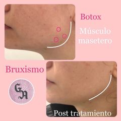 Bótox - Dra. Gracia Alonso