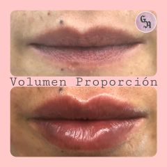 Aumento de labios - Dra. Gracia Alonso