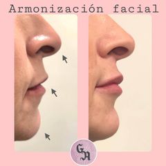 Aumento de labios - Dra. Gracia Alonso