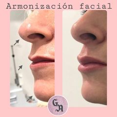 Aumento de labios - Dra. Gracia Alonso