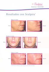 Antes y después rejuvenecimiento facial - Sculptra