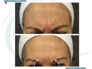 Antes y después Botox entrecejo 