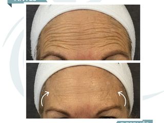 Antes y después Botox en la frente