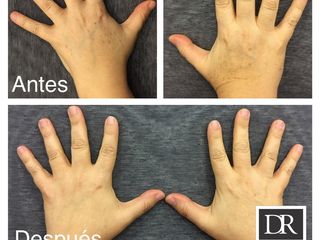 Antes y después Despigmentante - Rejuvenecimiento laser manos 