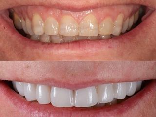 Antes y después carillas dentales