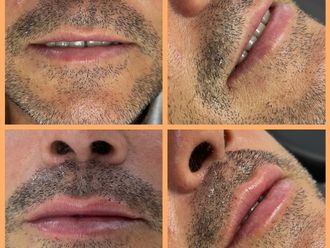 Aumento labios antes y después - 878502