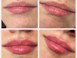 Aumento labios antes y después - 878503