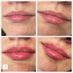 Aumento de labios