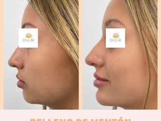 Rellenos faciales antes y después - 878504