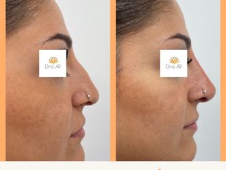 Rinomodelación antes y después - 878505