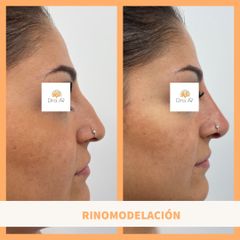 Rinomodelación