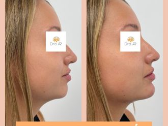 Rellenos faciales antes y después - 878506