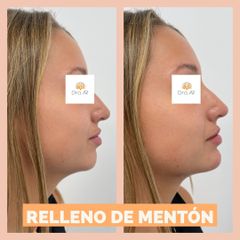 Relleno de mentón